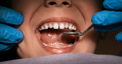 Rotten result? Kids' cavities would increase by millions if every state banned fluoride